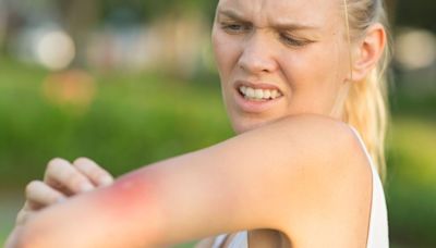 Pharmacist explains how to treat common summer insect bites