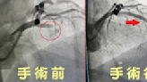 45歲健康男子竟突心絞痛昏倒 醫關鍵72分鐘搶救傻眼：「1動脈100%阻塞」