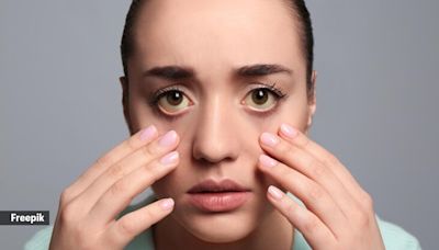 Those under eye dark circles could be indicating a more serious health problem; learn what they are