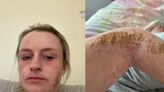 A 25-year-old ended up bedbound and covered in scabs from a skin condition that some doctors don't believe exists