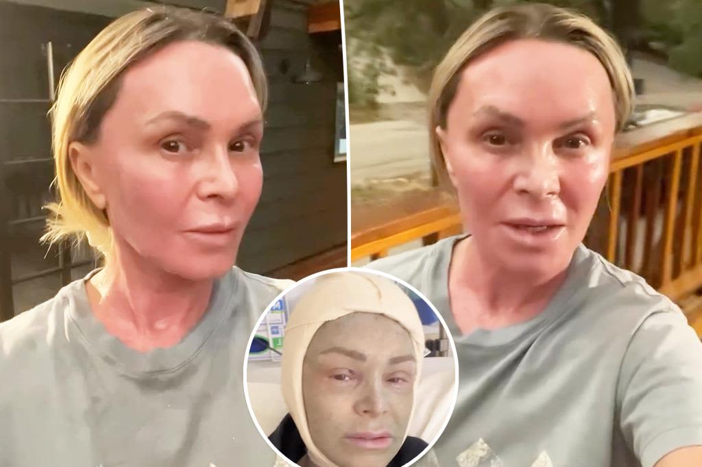 Tamra Judge shares update on ‘sanded and revarnished’ face after plastic surgery: ‘The worst of it is over’