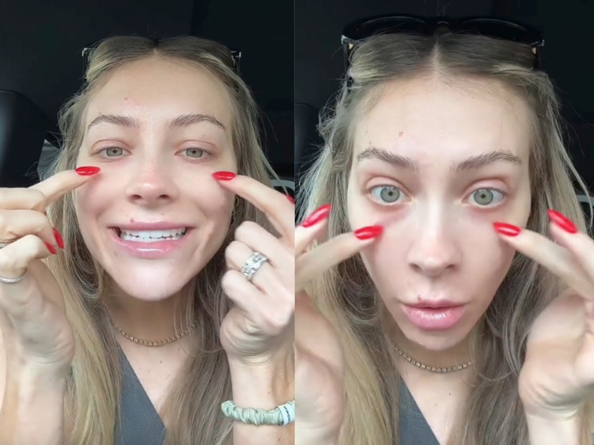 Woman shares why she regrets getting under eye filler