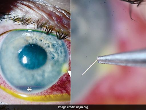 Man In US Left With Stinger In Eye After Bee Attack
