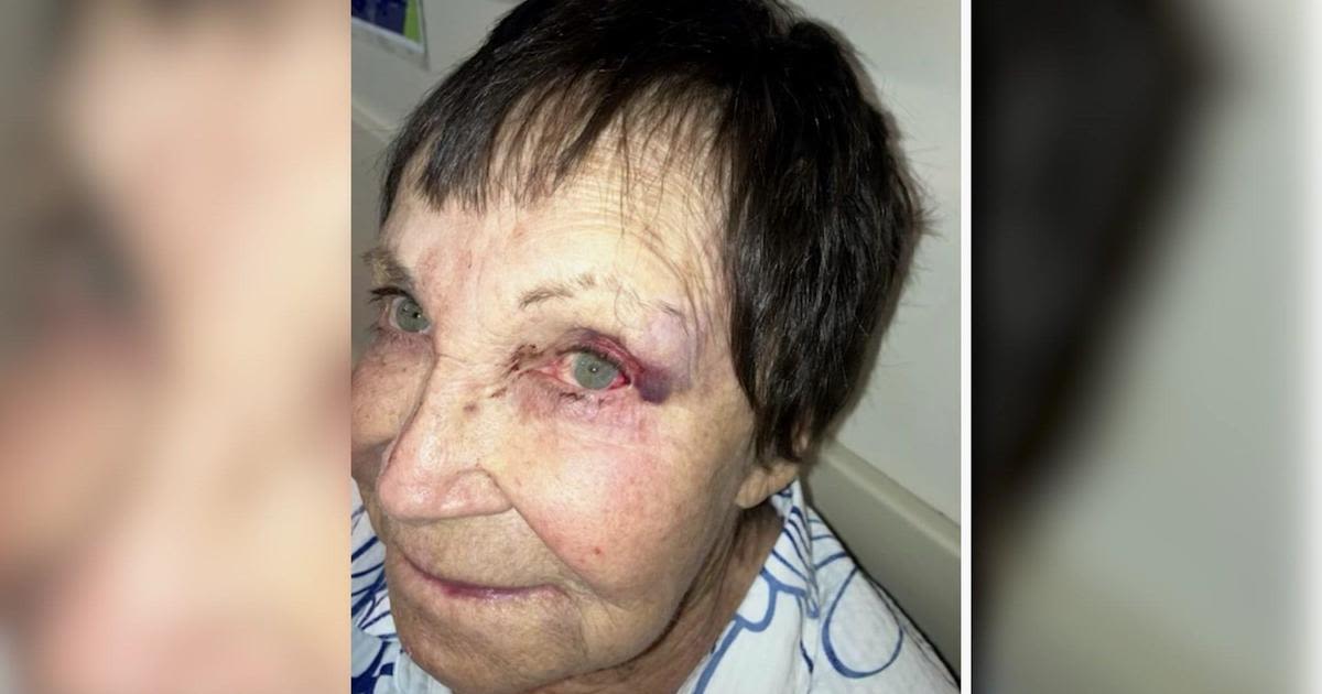 89-year-old stand-up comedian sucker-punched in West Village: "I thought I'd lost my eye"