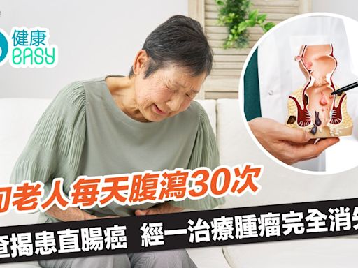 癌症｜8旬老人每天腹瀉30次終確診直腸癌！經這治療腫瘤完全消失