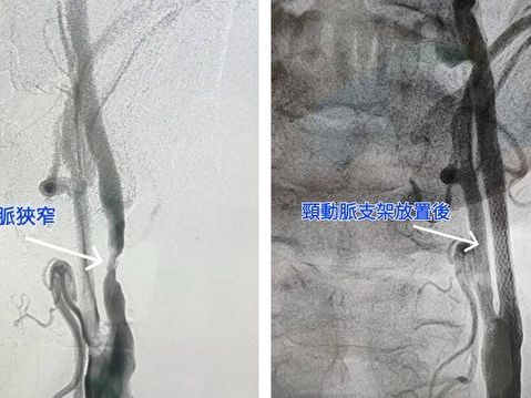 嚴重頸動脈狹窄釀中風症狀 頸動脈支架置放術助改善