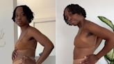 Woman has uterine fibroids removed that equaled the size of a 6-month pregnancy