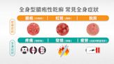 皮膚也有重症！三大皮膚病症可能是「全身型膿疱性乾癬」專家解說治療新進展｜Heho Topics