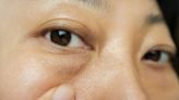有眼袋老10歲！眼袋手術內開、外開差在哪？ 醫解答「兩者差異、適用對象」