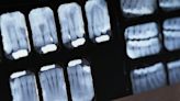 Lead aprons no longer necessary for dental X-rays