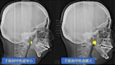 正顎手術改善睡眠呼吸中止 飲食作息先控管 - 自由健康網