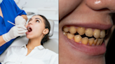 Expert explains how to avoid getting yellow teeth after dentist shared common mistake people make