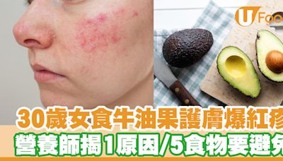 30歲女食牛油果護膚爆紅疹 營養師揭1原因 5類食物要避免 | U Food 香港餐廳及飲食資訊優惠網站