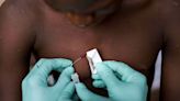 Emergencia por viruela del mono: la vacuna y lo que puede ayudar a controlar el actual brote