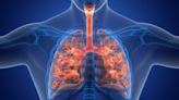 Why It's A New Day For COPD Patients — And 3 Biotech Stocks