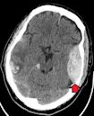 Epidural hematoma