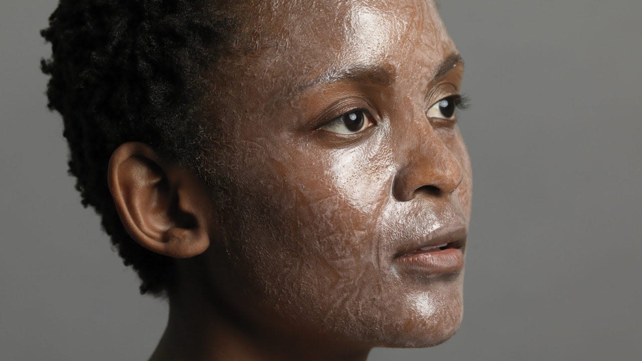 Everything Black Women Need To Know About Chemical Peels | Essence