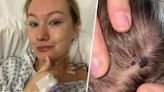 Skin Cancer On Woman's Scalp Diagnosed As Fungus. It Was Melanoma