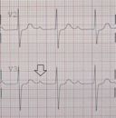 First-degree atrioventricular block