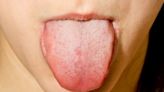 舌頭痛小心是自律神經失調！醫揭「痛點對應疾病」 含冰水、吃2類食物都有助解痛