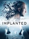 Implanted