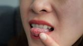 Unusual tongue symptom reported as new Covid variant causes concern