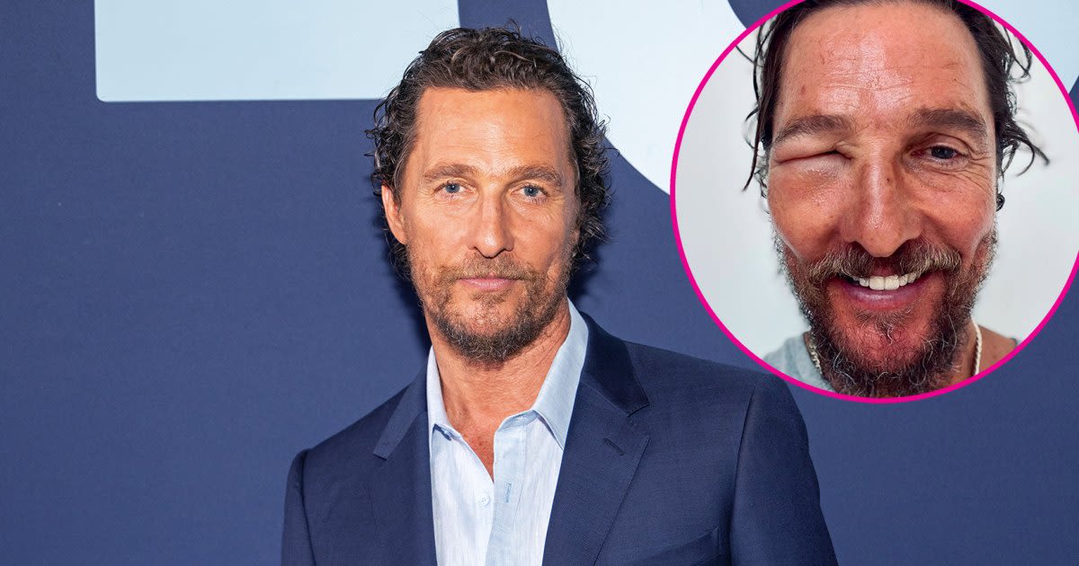 Matthew McConaughey’s Eye Is Swollen Shut After Bee Sting