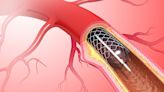 Radial PCI Procedures Have Almost Tripled in a Decade