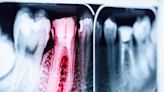 瑞士研究：除了三高會導致心臟病，一口爛牙可能也是禍首？