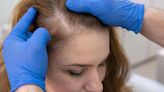 Pesquisadores revertem queda de cabelo causada por alopecia
