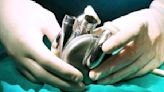 Titanium Heart Implant: Milestone In Medical Science