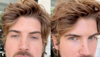 YouTuber Joey Graceffa reveals he’s been diagnosed with skin cancer