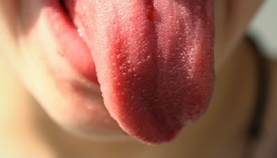 舌頭狀況代表罹癌？小哥出現1舌徵 醫師驚：肺癌二期
