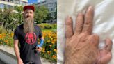 Carpenter who sawed off fingers has 'second chance' after toe transplanted onto hand