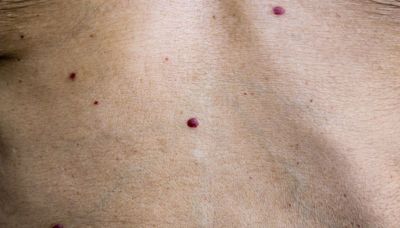 What causes 'weird red dots' on your skin – and when you should really worry