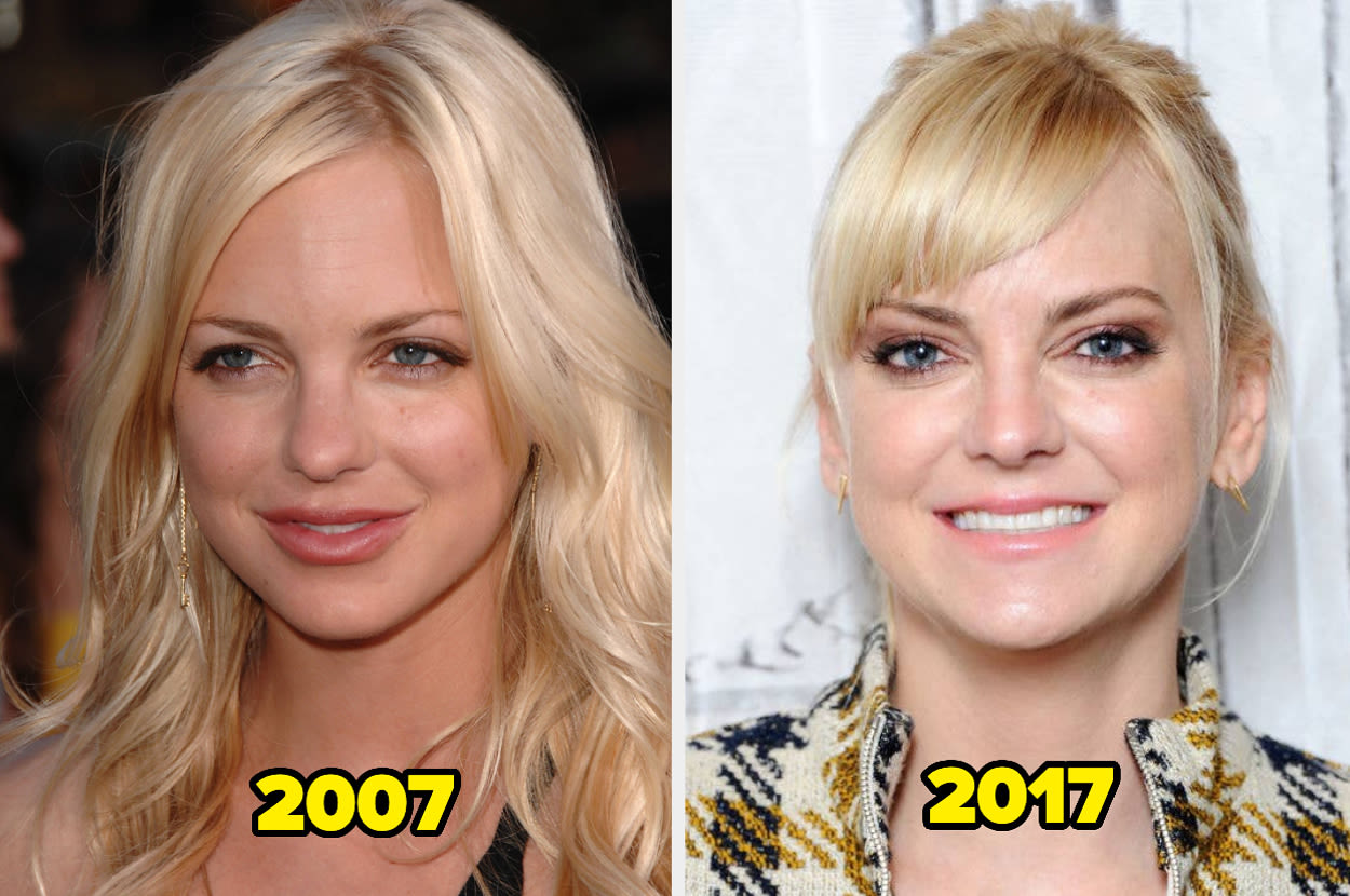 17 Celebs Who Dissolved Or Stop Getting Facial Fillers (And Why)