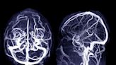 Statins, metformin associated with lower risk of brain aneurysms