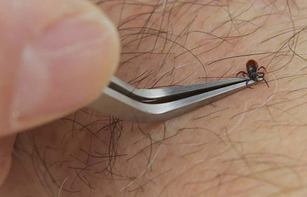 The Best Way to Remove a Tick? Use This Two-Sided Tool