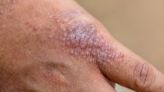 Rapid Rx Quiz: New Agents for Treating Atopic Dermatitis