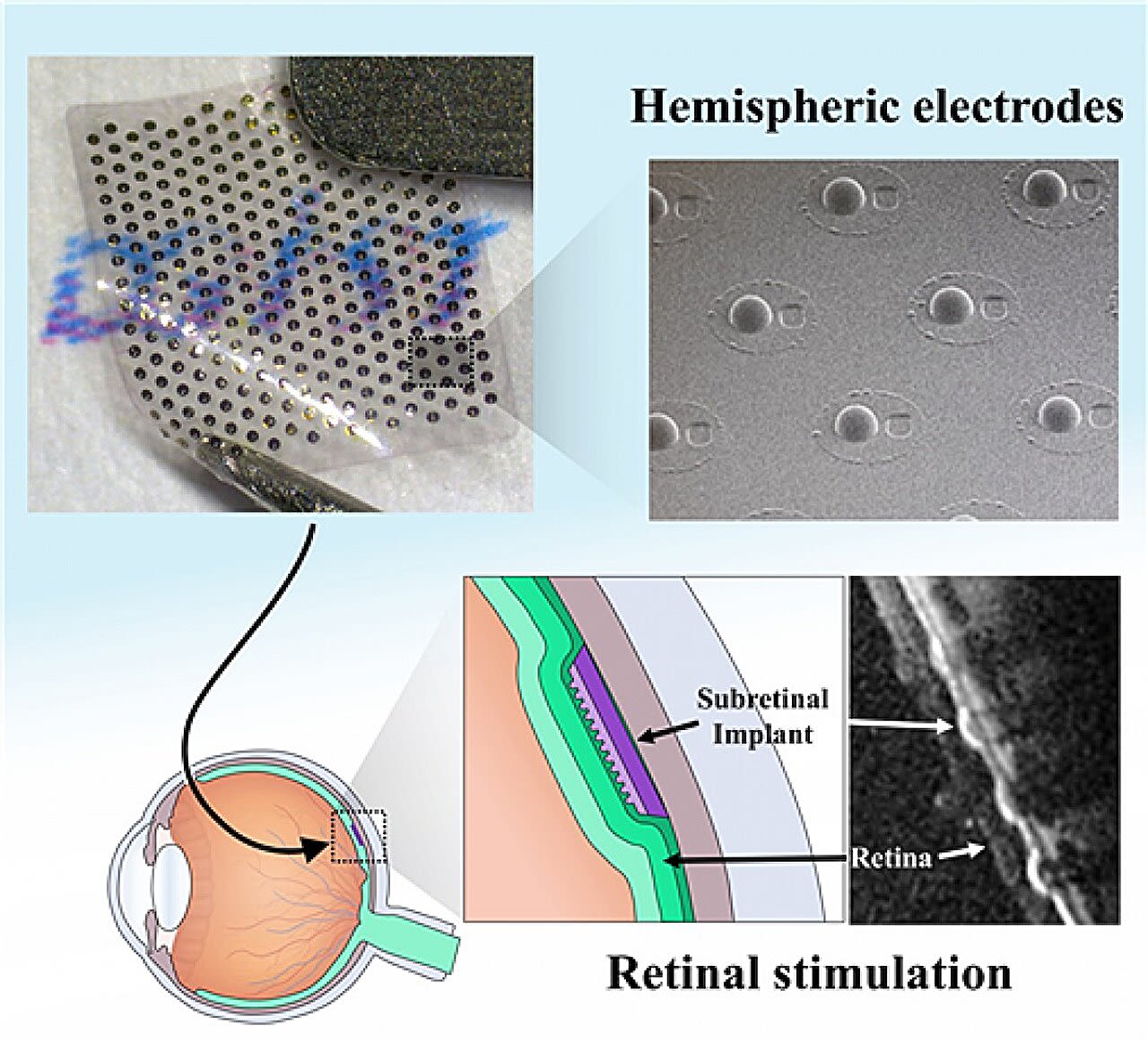 Three-dimensional retinal electrodes in a convex Braille shape partially restore sight