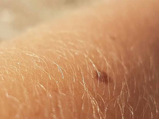 Dermatólogo advierte sobre extraño síntoma en la piel que podría ser una señal temprana de cáncer