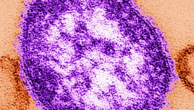 Traveler infected with measles flew into LAX, visited Orange County