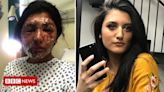 100 Women: Resham Khan pities man who threw acid on her