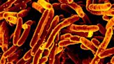 Second deadly TB outbreak linked to tainted bone grafts