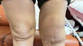 30歲女曾患惡性骨腫瘤 一次搬家後左膝突腫成「麵龜」 - 自由健康網