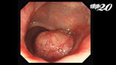 大便有血是痔瘡或息肉？老翁腸息肉掉出肛門以為是痔瘡 檢查竟是大腸癌