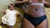 Everything To Know About Stretch Marks On Darker Skin | Essence