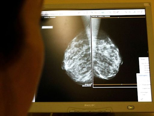 New breast cancer genes found in women of African ancestry, may improve risk assessment