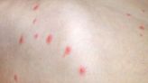 Varicella-Zoster Virus: Overlap Between Chickenpox and Shingles
