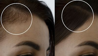 Minoxidil Before and After Transformations — See How 6 Women Reversed Hair Loss